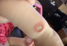 She Switched Her Inhaler — 48 Hours Later, Her Skin Erupted. Doctors Were Not Expecting This.