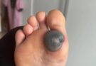 My daughter woke up with this huge spot on her foot I don’t know what it could be. She’s been in pain and can’t move her foot what is this.. Explain this